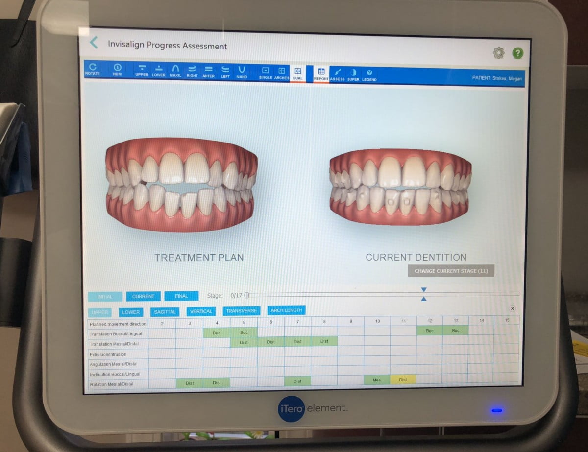 Invisalign Progress Update | Tatum Dentistry