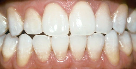Teeth Img