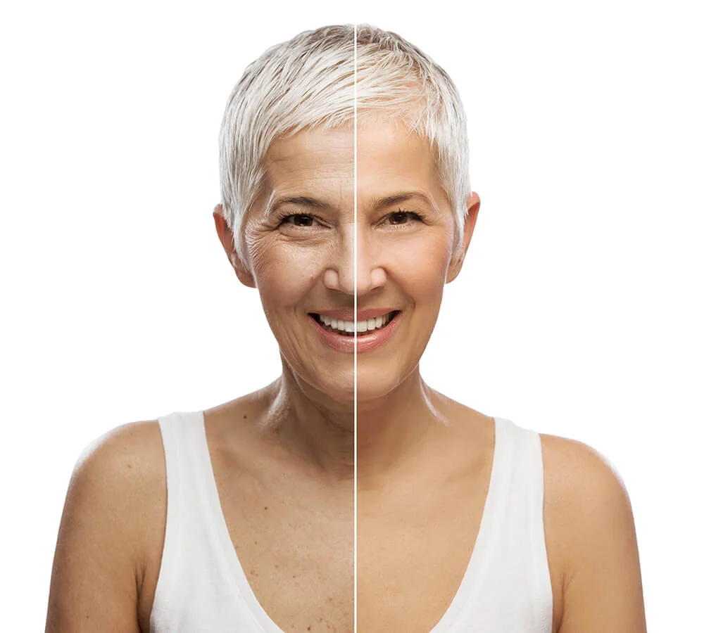 After Botox Treatment