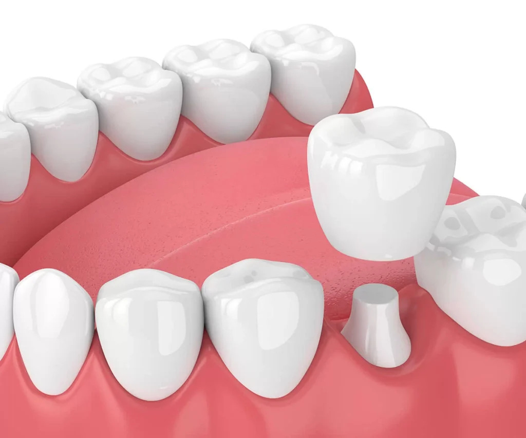Dental Crown Image